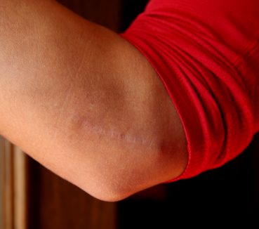 Tommy John Surgeries Remain a Concern in Baseball